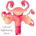 uterus shifted to the left