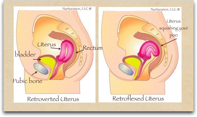 Tilted Cervix Symptoms