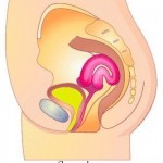 Retroverted Uterus a Natural Solution