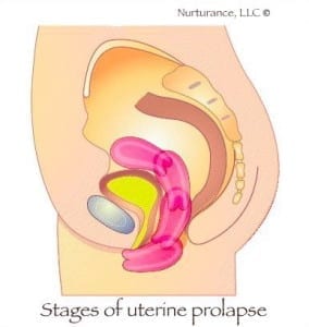 uterus prolapsing 