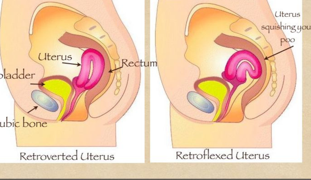 Retroverted Uterus a Natural Solution