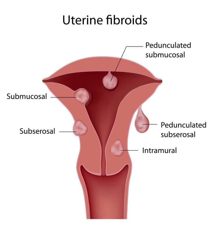 Different types of fibroids