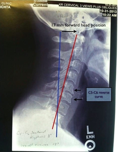 neck-x-ray-with-markups1