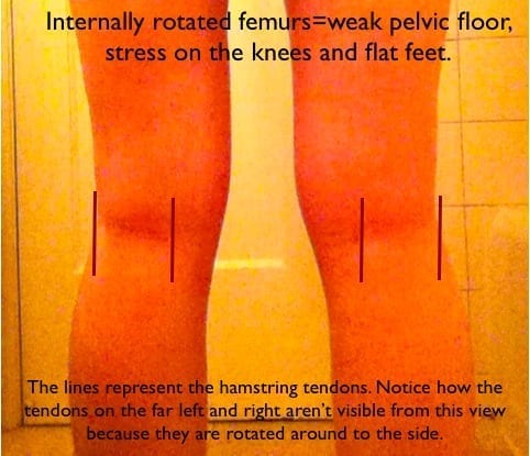 Are Your Femurs Internally Rotated?