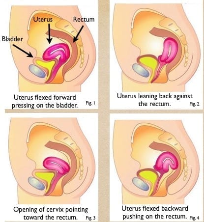 Figure 1. anteflexed uterus 2. retroverted uterus 3. retrocessed uterus 4. retroflexed uterus ©