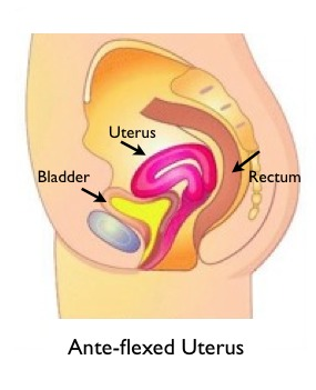 Anteflexed Uterus uterus tipped uterus on bladder