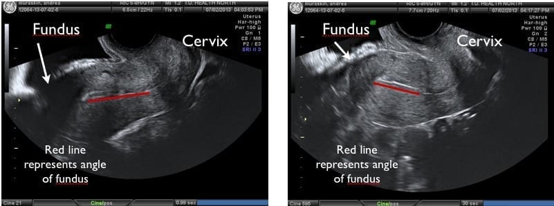 Uterine ultrasound