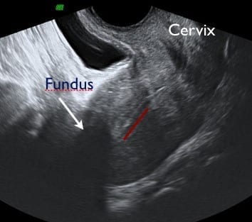 Reflexogenic Properties of Uterine Ligaments