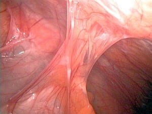 Adhesions after appendectomy