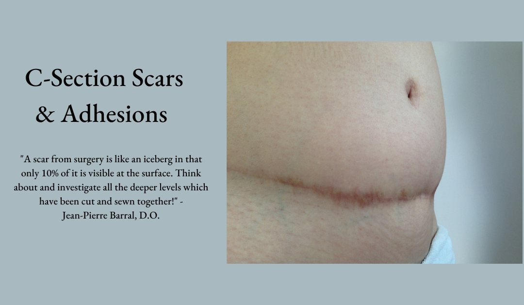 C-Sections Scars & Adhesions