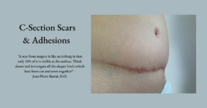 c section scar