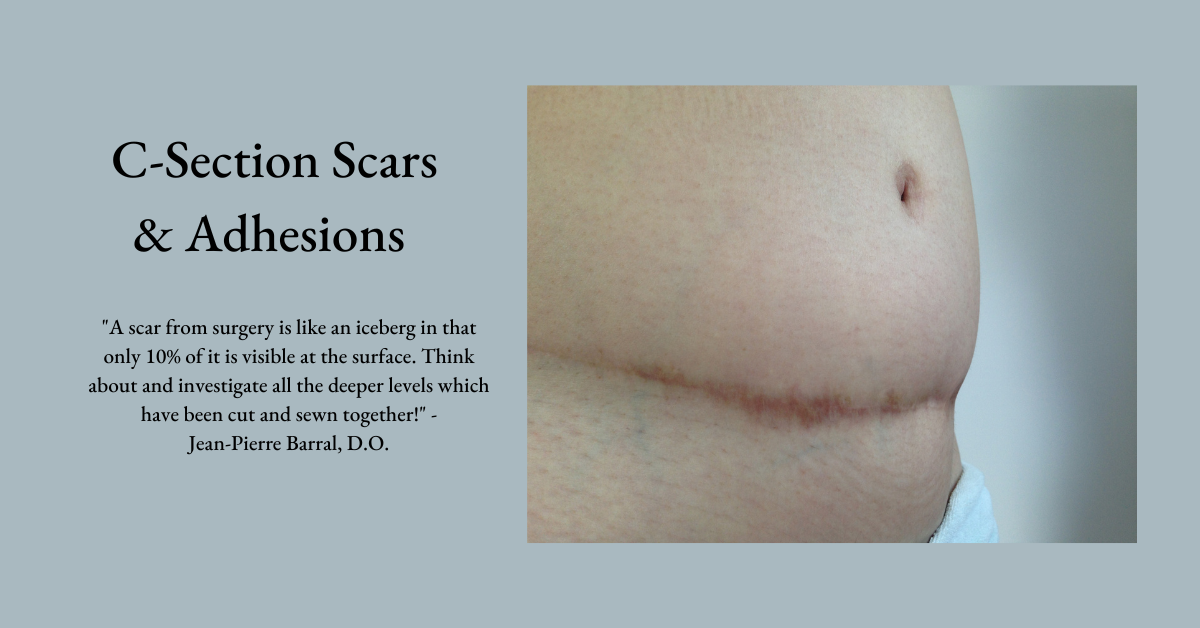 C-Section Scar Tissue Release Therapy - Cesarean Scar Massage