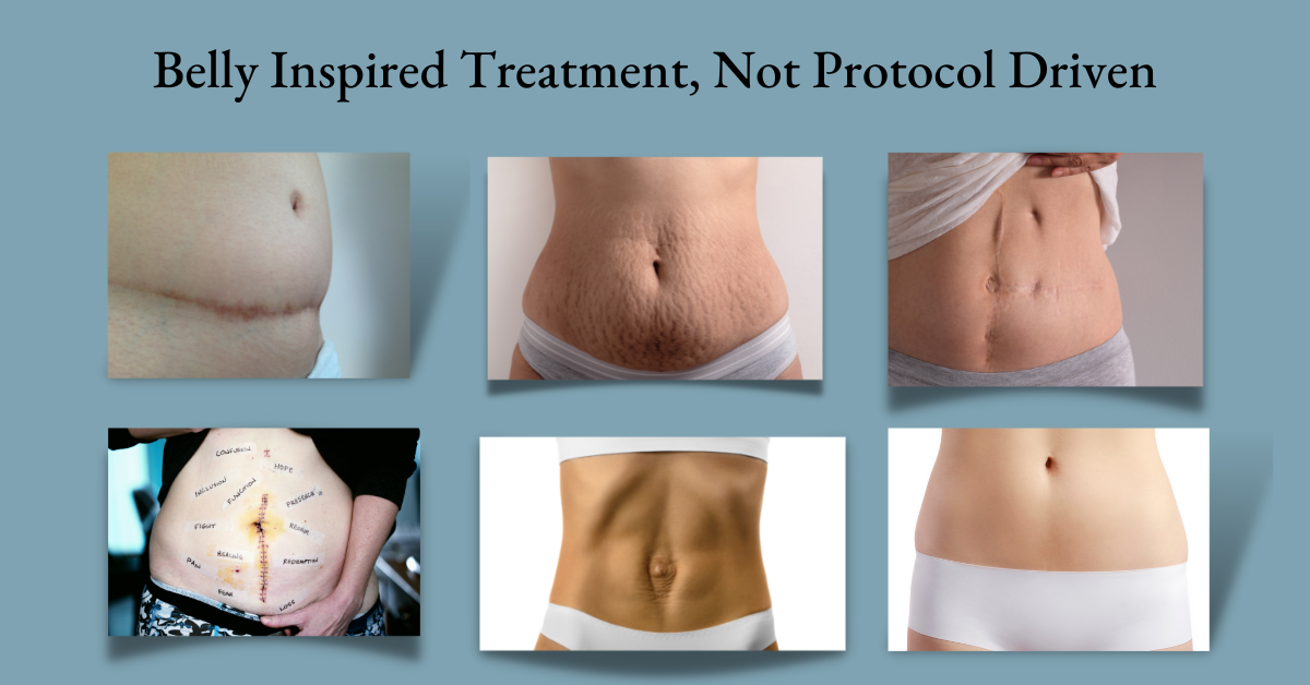 belly inspired treatment different abdomens diastasis recti