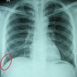 Costodiaphragmatic Recess in red circle.