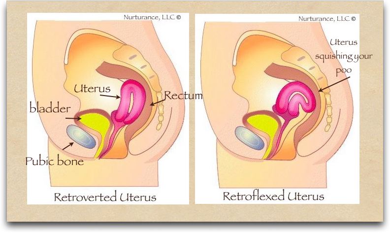 Tilted uterus and early pregnancy
